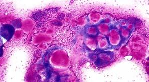 Metastatic small cell carcinoma/merkel cell carcinoma Metastatic