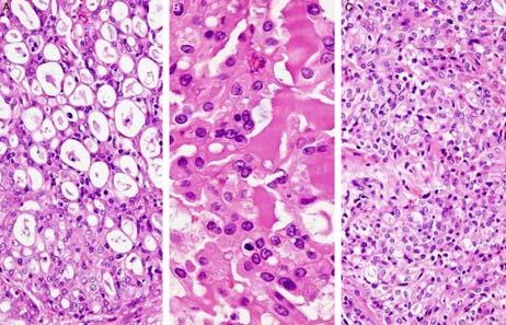gland tumors with morphologic