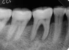 144 to perform root canal filling may be missed.
