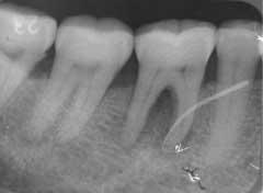 At the fourth visit, no clinical symptoms, such as pus discharge from the root canals or percussion pain, were observed, but the Periocheck score of the root canals remained plus.