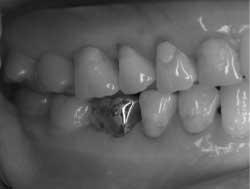 146 Fig. 7 Lateral view of right teeth and gingiva three months after root canal filling. A metal crown has been applied to tooth 46. Occlusal and gingival conditions are normal. Fig. 8 X-ray photograph of tooth 46 three months after root canal filling.