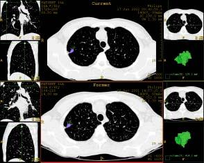 CT Breakthroughs in Cancer Detection Fast detection of lung cancer