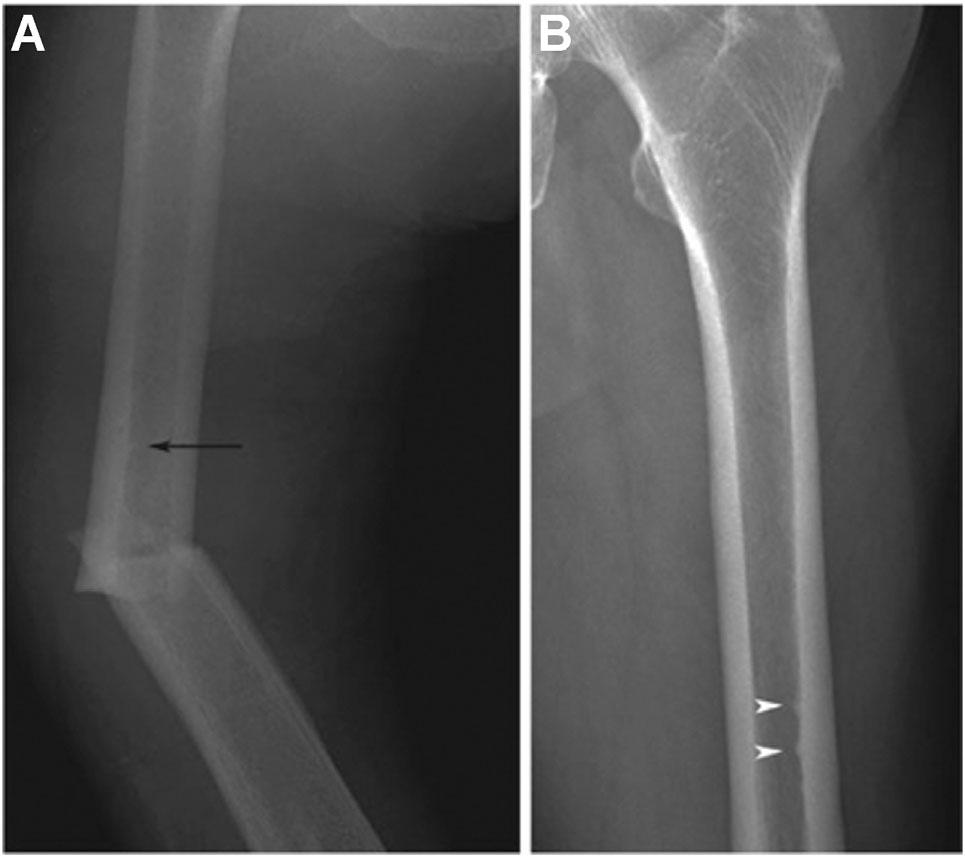 cases and was associated with a fivefold increased risk of subtrochanteric fractures in one series.