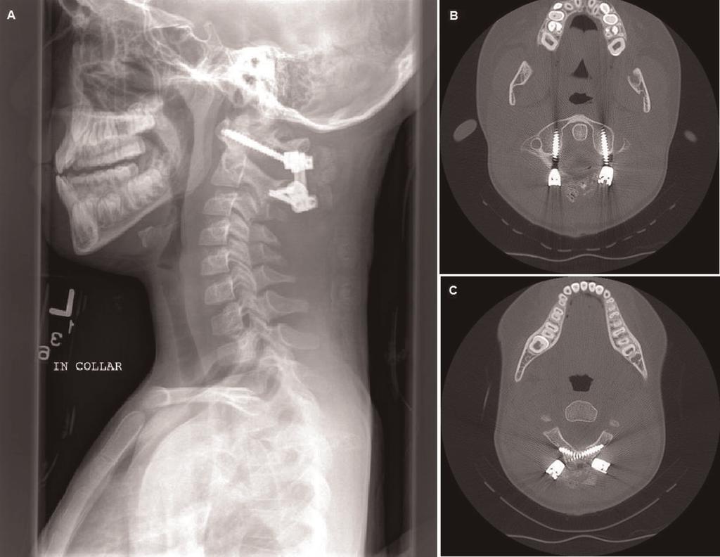 Cases Journal 2009, 2:8530 Figure 4. (A) Postop lateral cervical spine X-ray and axial CT of the cervical spine shows (B) C1 lateral mass screws and (C) bilateral crossing C2 translaminar screws.