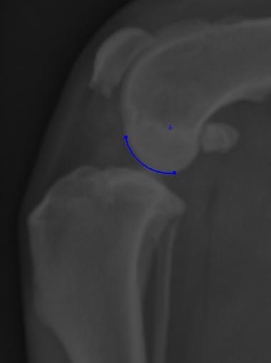 FCR FIGURE 31 - Femoral condyle radius (FCR) as determined by radiograph.