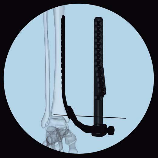 2 Position plate and fix provisionally Confirm the plate orientation, length, and distal location with fluoroscopy in the anteroposterior and lateral planes. Confirm the fracture reduction.