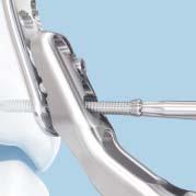 Be sure the plate is held securely to the bone to prevent rotation as the screw is locked to the
