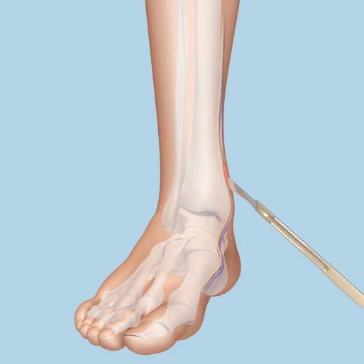 Approach Approach Make a medial incision through the skin and subcutis slightly above the level of ankle joint and over the medial malleolus and distal tibia.