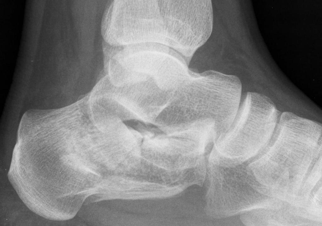 INCIDENCE 2% of all fractures Most commonly fractured tarsal bone