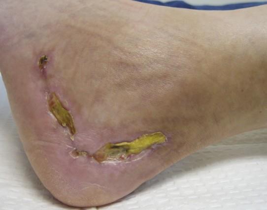 COMPLICATIONS CALCANEUS FRACTURE Wound edge necrosis Most common complication Up to 25% Deep infection 1-4% closed