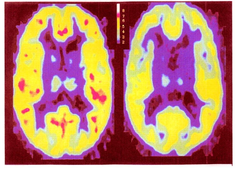 Position emission tomography (PET) scans of the brains of patients with panic disorder (right) show a significant global reduction in binding to the