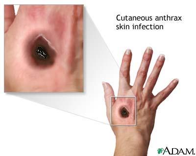 Anthrax (Naturally Occurring) No exposure to bioagent Anthrax reported Bacteria transmitted by animals, animal hides or contaminated meat Symptoms On skin.