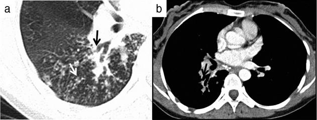 Airway involvement in tuberculosis Table 1. Spectrum of airway involvement in acute and chronic form of tuberculosis Fig. 1. Acute on chronic involvement of right lower lobe bronchus.