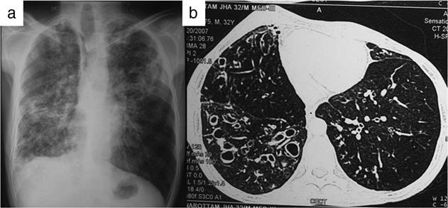 A Arora et al. Fig. 5. Bronchiectasis. Chest radiograph (a) with bronchiectasis in bilateral lung fields. Computed tomography image (b) showing cystic bronchiectasis in both lungs.