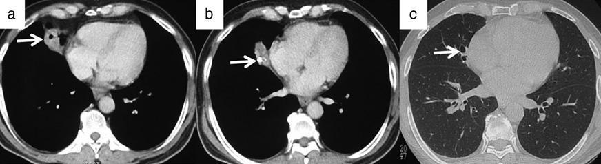 Radiological findings in chronic airway involvement Tracheal stenosis Endotracheal TB is a relatively uncommon (about 4%), localised form of endobronchial TB, which may cause acute respiratory