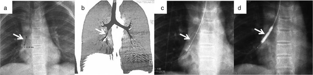subsequent damage to bronchial walls as bronchiectasis is often seen in areas without surrounding fibrosis or proximal stenosis.