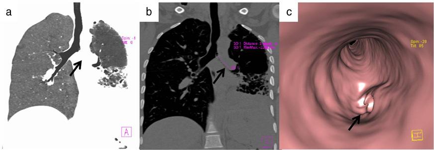 (Fig. 6). Findings of calcium near an area of pulmonary collapse (Fig. 7) should arouse suspicion of a broncholithiasis.