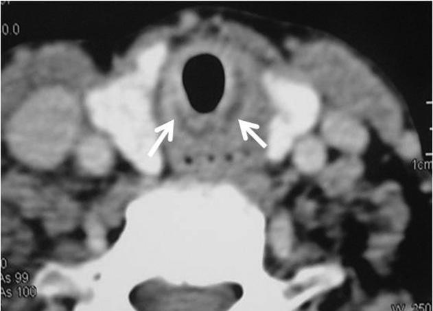 5,16 Clinical signs of haemoptysis or pneumonitis may be the presenting symptom. Fig. 9. Amyloidosis of tracheobronchial wall.