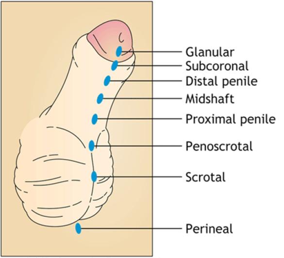Pediatric Urologic Disorders Hypospadias DEFINITION AND DIAGNOSIS Hypospadias is an abnormally located opening of the urethral meatus anywhere along the ventral aspect of the penis from the glans to