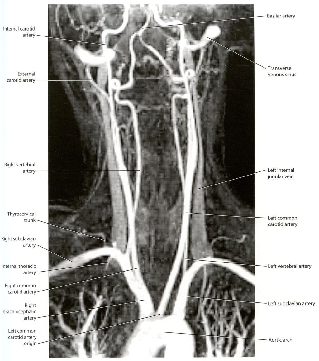 Blood Supply for the Brain Arteries & Veins [MRI with