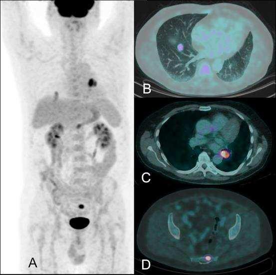 Figure 2: Use of FDG PET-CT to stage potentially operable metastatic colorectal carcinoma A.