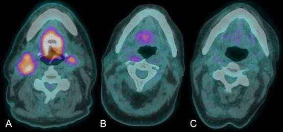 Figure 3: Use of FDG PET-CT in response assessment of head and neck cancer following chemo-radiotherapy A.