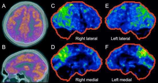 Figure 4: Use of FDG PET-CT in Suspected Dementia A-B. C-F.