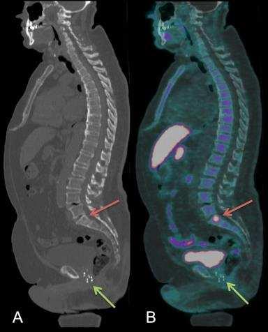 Figure 5: Use of Choline PET-CT in suspected recurrence of prostatic carcinoma A.