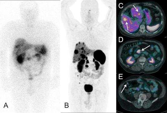 Figure 6: Use of Gallium-68 labelled somatostatin receptor (SSR) PET-CT in neuroendocrine malignancy A.