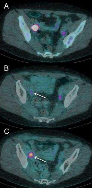 Figure 7: Use of FDG PET-CT for assessment of treatment response following chemo-radiotherapy in locally advanced cervical carcinoma A.