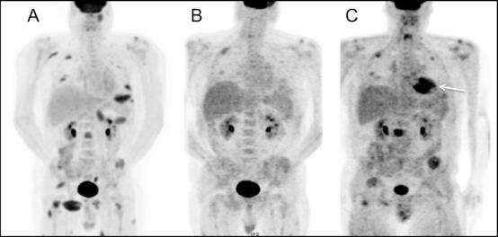 Figure 8: Use of FDG PET-CT in assessment of non-secretory multiple myeloma pre and post treatment A.