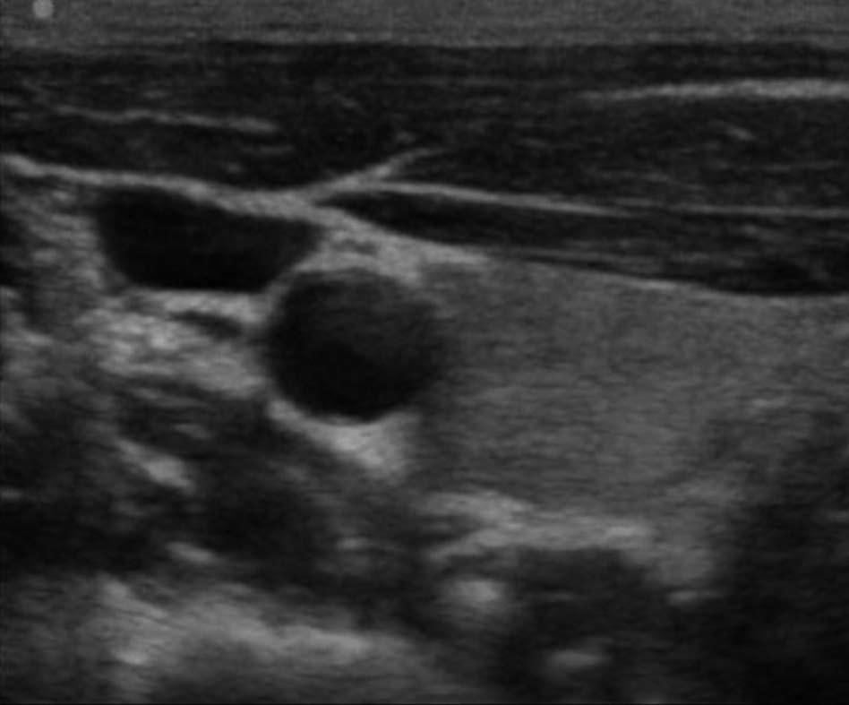 IJV CA BV BA BV Figure 1 Ultrasound visualization of the internal jugular vein and the carotid artery on the right side of the neck. IJV: Internal jugular vein; CA: Carotid artery.