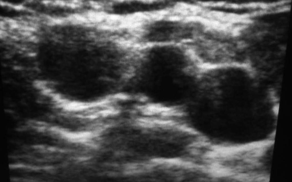Figure 3 Ultrasound-guided venipuncture of the axillary vein.