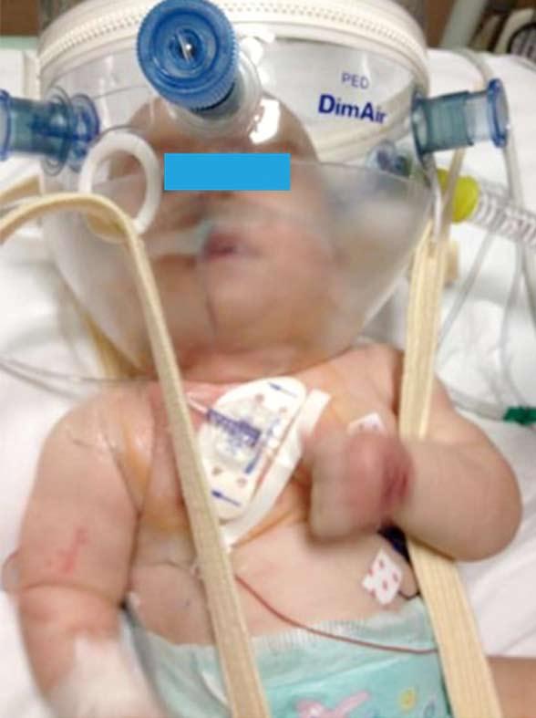 Figure 8 A neonate in intensive care unit with a centrally inserted central catheter. Figure 9 A children in intensive care unit with a peripherally inserted central catheter.