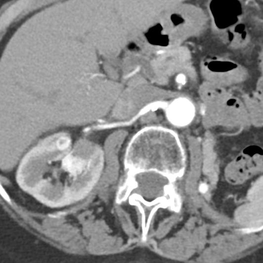 noncontrast nephrographic Pancreatic and Contralateral