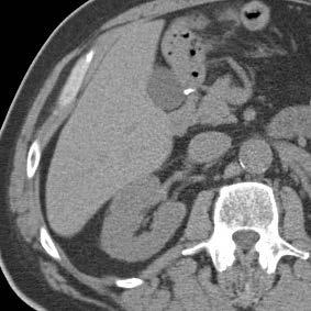 RCC status post partial left nephrectomy with