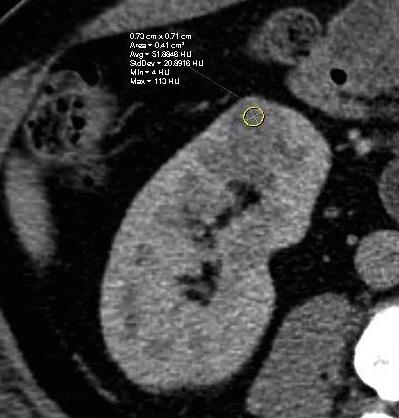 Contralateral Kidney Metastases 59 year old man status post