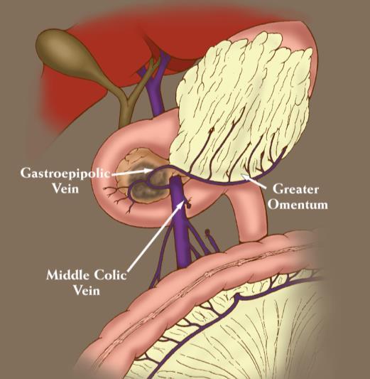 The Whipple Operation (Pancreaticoduodenectomy)