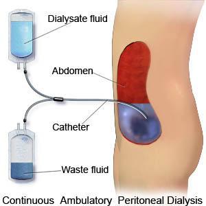 PERITONEAL DIALYSIS (PD) Peritoneal dialysis is a home treatment. Peritoneum tiny blood vessels. Filter to clean the blood. Access is through a catheter placed through the wall of the abdomen.