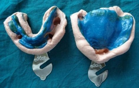 The patient was adamant to deny for extractions or modify his teeth in terms of undergoing intentional root canal treatments for overdentures.
