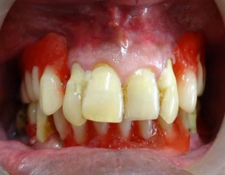 During the insertion appointment, the holes underneath the denture surface were scraped to create some space for soft liner