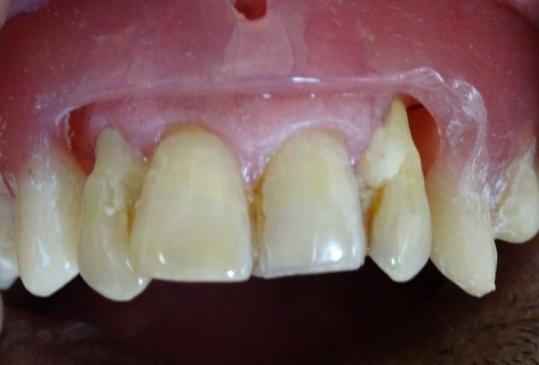 Fig 7: Space occuring between denture border and teeth soft tissues is taken up by soft liner and contoured in harmonious accordance with adjacent tissues.