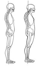 backward shift of the upper trunk Accompanied by: Rounded shoulders Sunken chest Forward-tilted head Sway-back