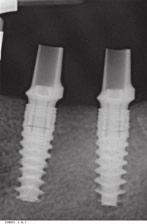 NobelActive technical and clinical story 5 Insertion torque The torque necessary to insert different implant designs cannot be compared directly.