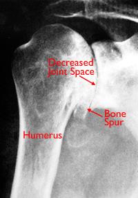 This x-ray shows severe osteoarthritis of the glenohumeral joint. To confirm the diagnosis, Mr.Chandrasekaran may inject a local anesthetic into the joint.