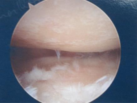 Arthroscopic Debridement Arthroscopic debridement of synovium, labrum and loose articular cartilage Biceps tenotomy Subacromial decompression Rotator interval and capsular release ACJ excision