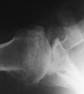 Glenohumeral Arthritis Osteoarthritis Posterior glenoid erosion