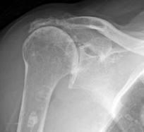Glenohumeral Arthritis Inflammatory Arthritis Peri-articular erosions and osteopenia Adjacent joint involvement