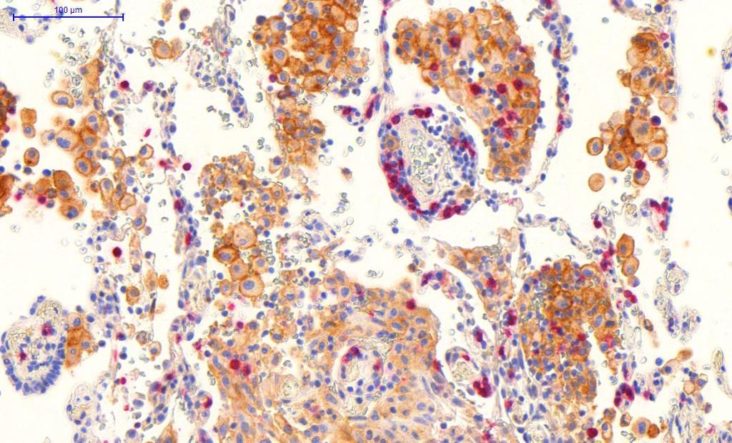 Phase 2 tumor biopsies show strong PD-L1 staining