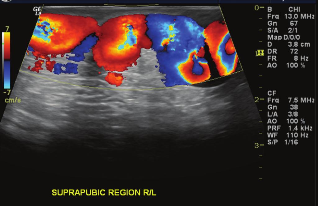 2 Case Reports in Vascular Medicine Figure 1: Duplex ultrasound of